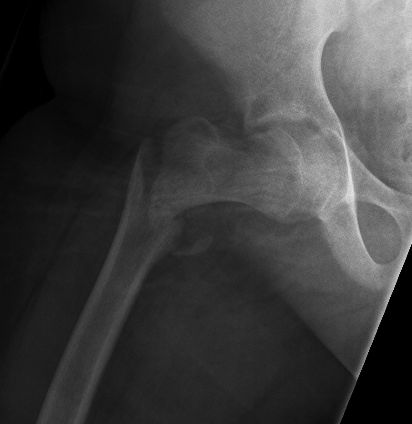 Paediatric Intertrochanteric Hip Fracture